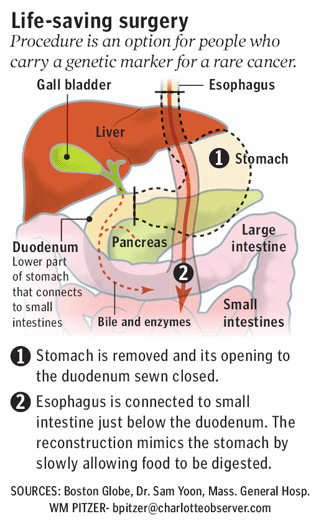 Stomach surgery